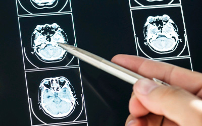 Страдает центральная нервная система и ее «руководитель» — головной мозг - клиника Квинмед
